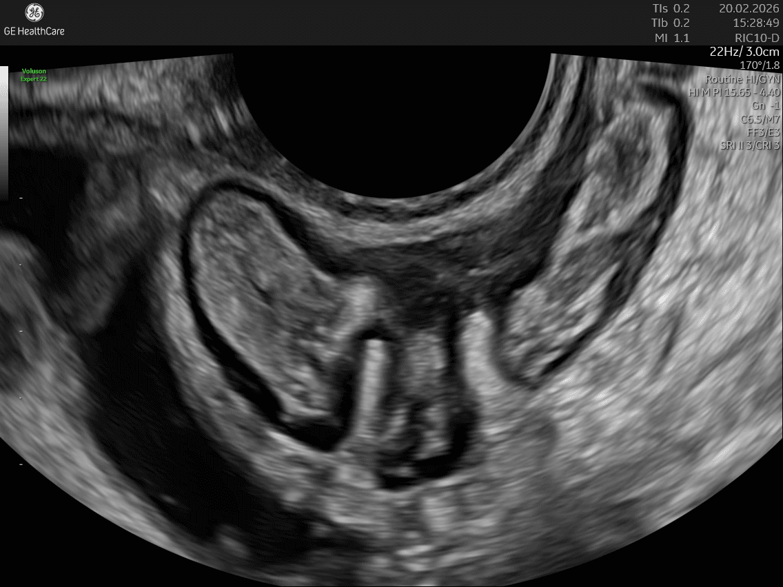 Nodulo di endometriosi rettale